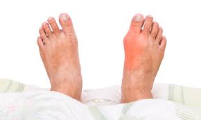 Gout! What is it and how to treat it?
